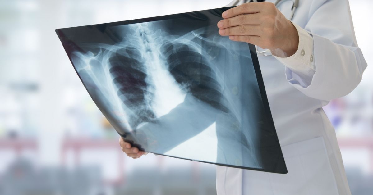 Doctor looking at lung x-ray.